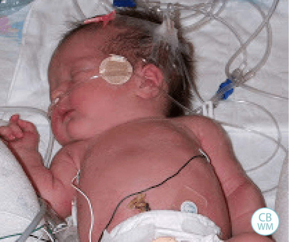 Preterm baby in the NICU