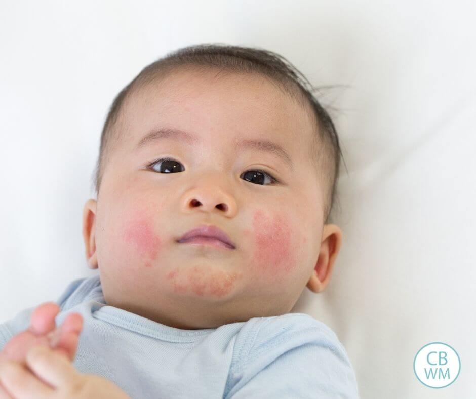 Baby with eczema