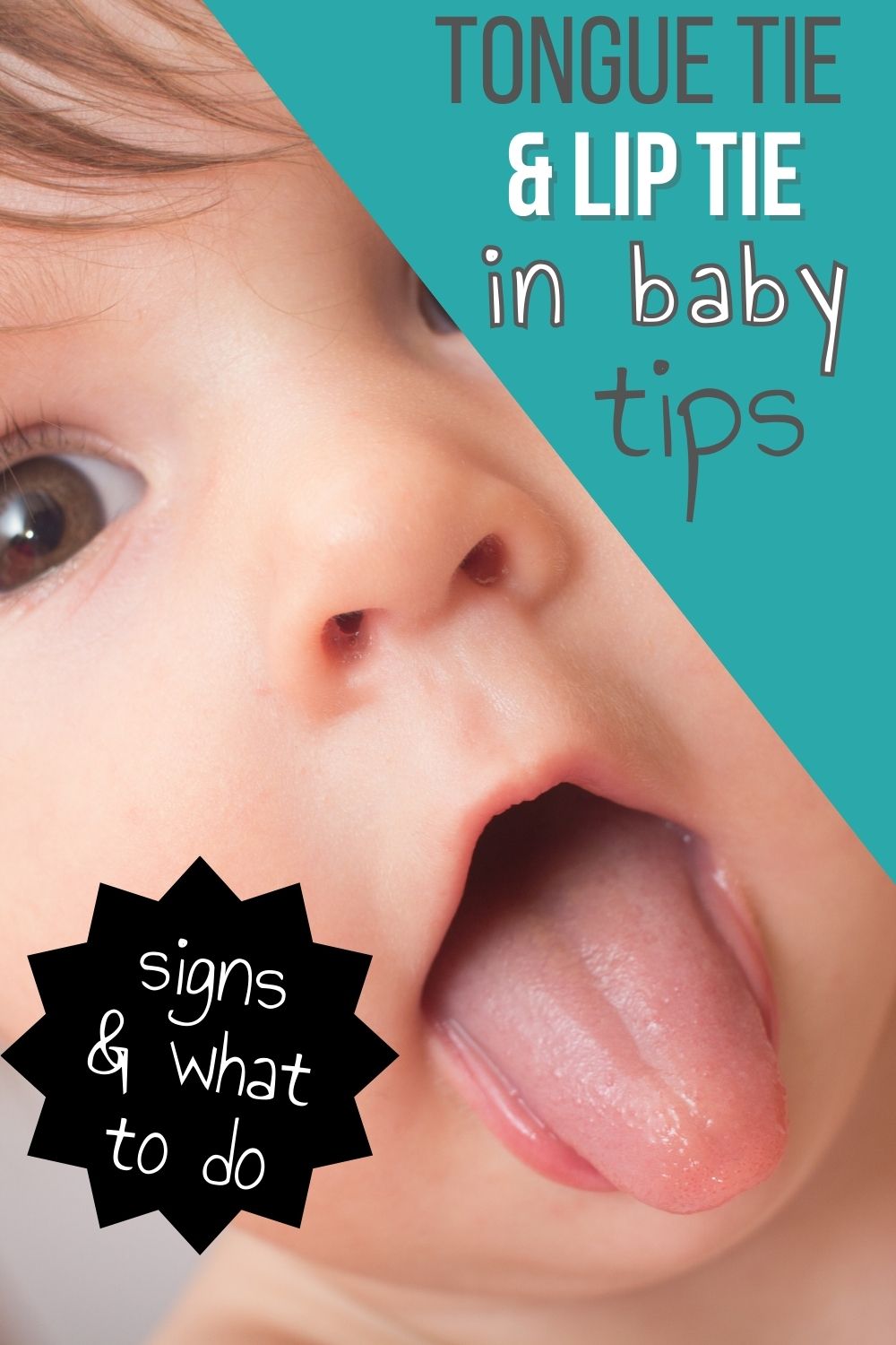 tongue tie and lip tie in baby tips pinnable image