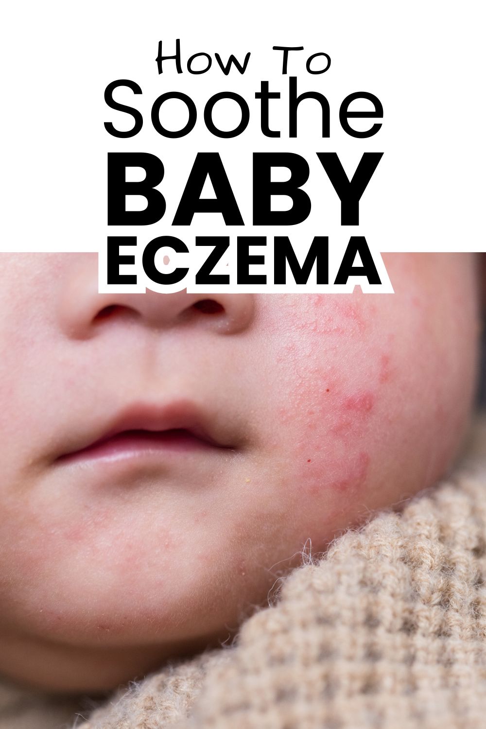 Surviving Eczema with Kids