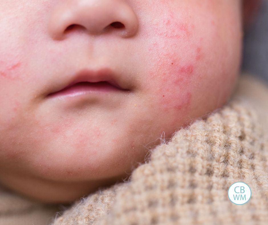 Eczema on baby face