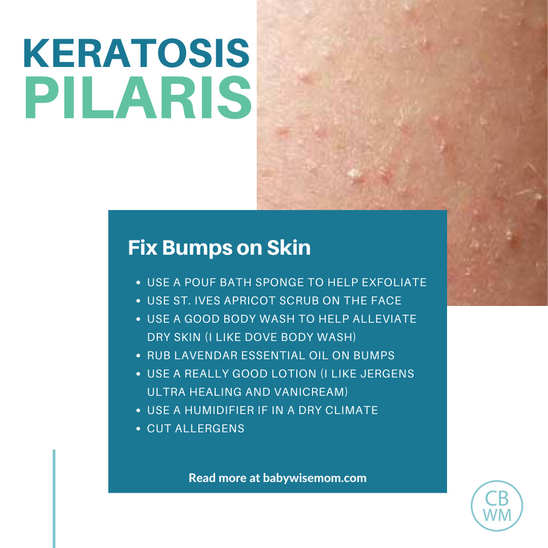 Keratosis Pilaris bumps on skin fixes graphic