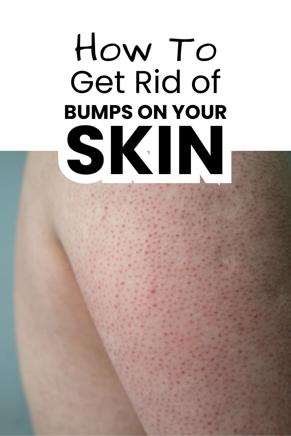 Get rid of bumps on skin pinnable image