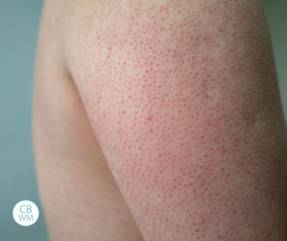 Keratosis pilaris on the skin