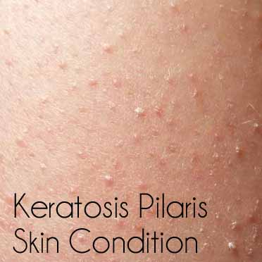 Keratosis Pilaris Bumps On Skin Babywise Mom