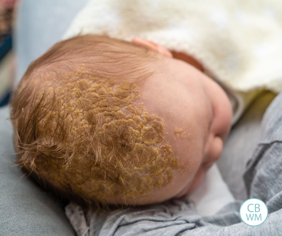 Cradle cap on baby's scalp